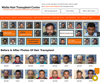 Hair Transplant in Ludhiana