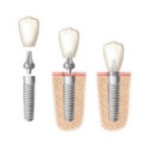 Dental Implant Overseas