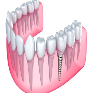 Multiple Tooth Implant Sydney