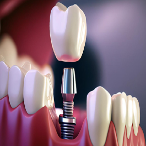Cost of Dental Implants