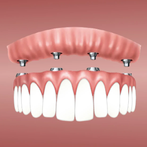 cheap dental implants Melbourne