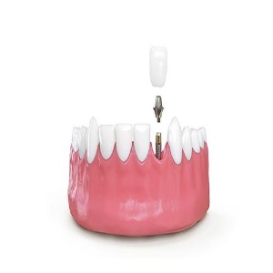 Serenity Smiles Dental | General Dentistry, Cosmetic Dentistry, Orthodontic-https://www.serenitysmilesdental.com.au/